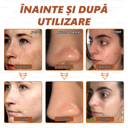 💟💟FRISSARC™ masca facială  pentru albire și îndepărtarea petelor –🍀Ingredientele naturale ajută la eliminarea eficientă și de durată a petelor pigmentare, petelor de vârstă, pistruilor și petelor solare.