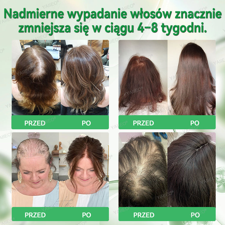 🌿 𝐘𝐀𝐈𝐈𝐄𝐎® Bezbolesny System Mikroinfuzji Głębokie blokowanie DHT, reaktywacja mieszków włosowych i widoczny wzrost włosów