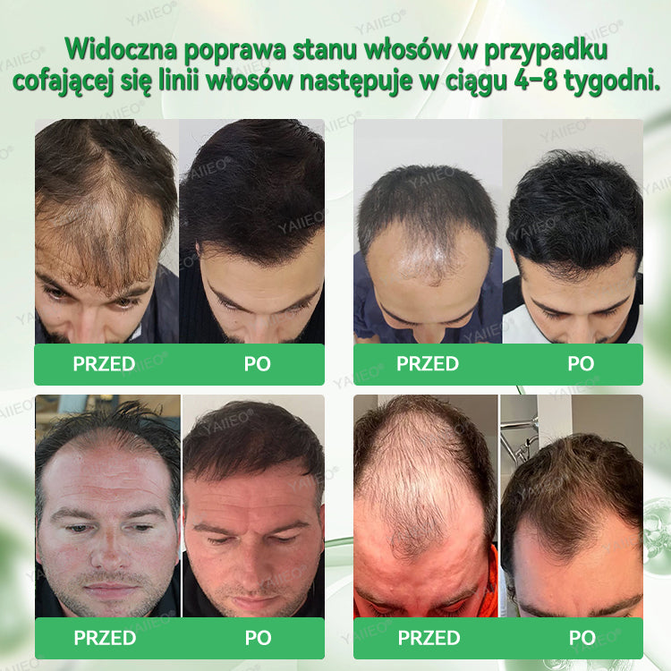 🌿 𝐘𝐀𝐈𝐈𝐄𝐎® Bezbolesny System Mikroinfuzji Głębokie blokowanie DHT, reaktywacja mieszków włosowych i widoczny wzrost włosów