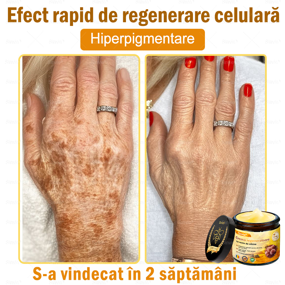 🧑‍⚕️Recomandat de dermatologi 🐝 Crema regeneratoare Sinvie® cu venin de albine 🔥 Ideală pentru riduri, pete pigmentare și piele lipsită de fermitate – 50 ml