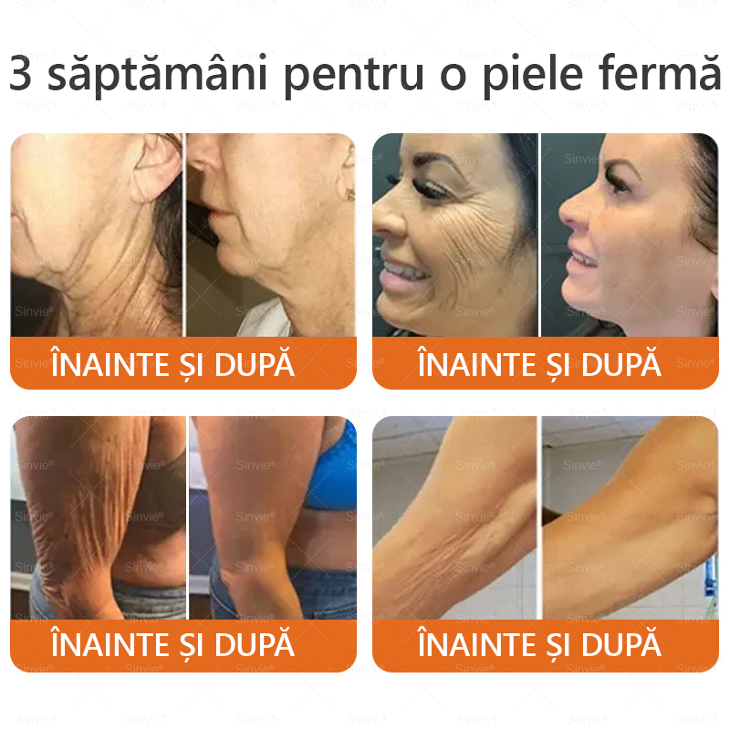 🧑‍⚕️Recomandat de dermatologi 🐝 Crema regeneratoare Sinvie® cu venin de albine 🔥 Ideală pentru riduri, pete pigmentare și piele lipsită de fermitate – 50 ml