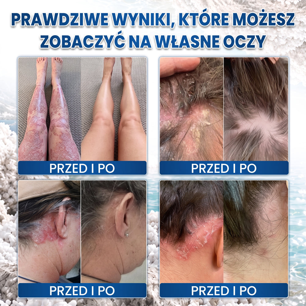 Medistart® Specjalistyczna Pielęgnacja Skóry z Łuszczycą
