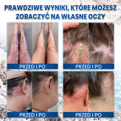 Medistart® Specjalistyczna Pielęgnacja Skóry z Łuszczycą