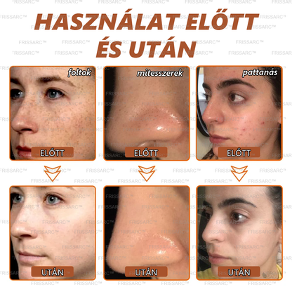 𝐅𝐑𝐈𝐒𝐒𝐀𝐑𝐂™ Fehérítő És Folteltávolító Arcmaszk | Természetes összetevők tartósan eltüntetik a foltokat, szeplőket és napfoltokat🔥