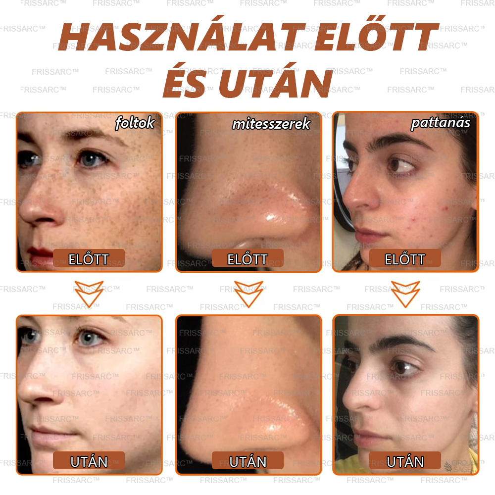 𝐅𝐑𝐈𝐒𝐒𝐀𝐑𝐂™ Fehérítő És Folteltávolító Arcmaszk | Természetes összetevők tartósan eltüntetik a foltokat, szeplőket és napfoltokat🔥