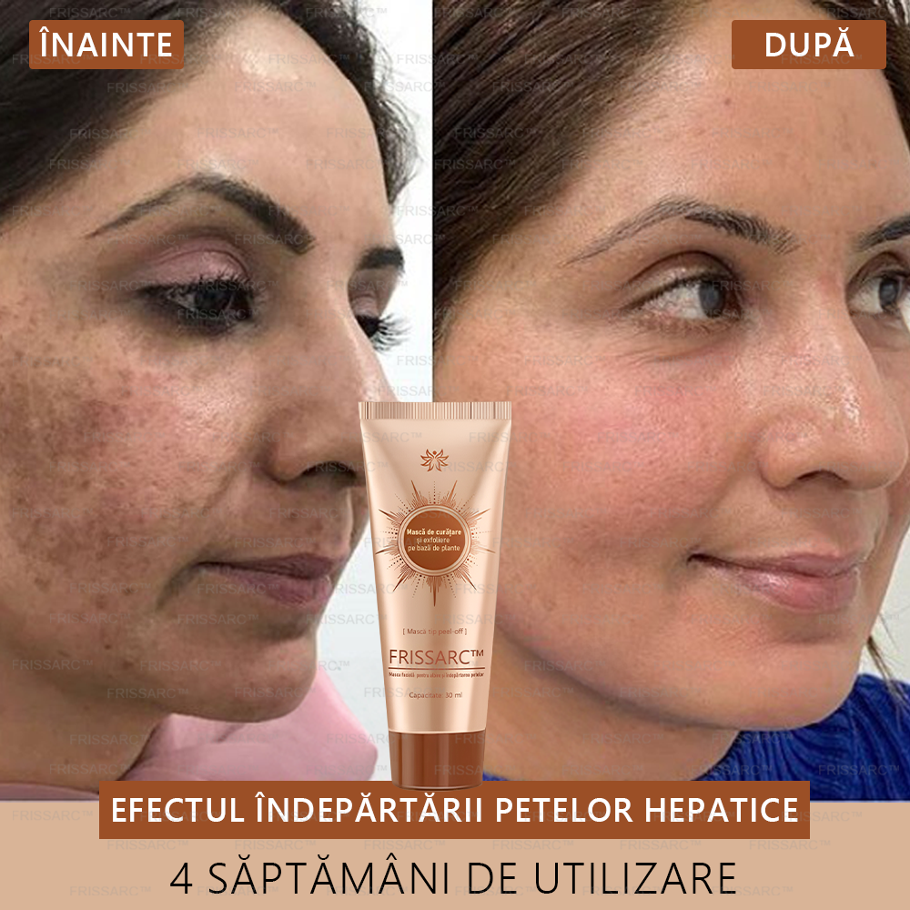 💟💟FRISSARC™ masca facială  pentru albire și îndepărtarea petelor –🍀Ingredientele naturale ajută la eliminarea eficientă și de durată a petelor pigmentare, petelor de vârstă, pistruilor și petelor solare.