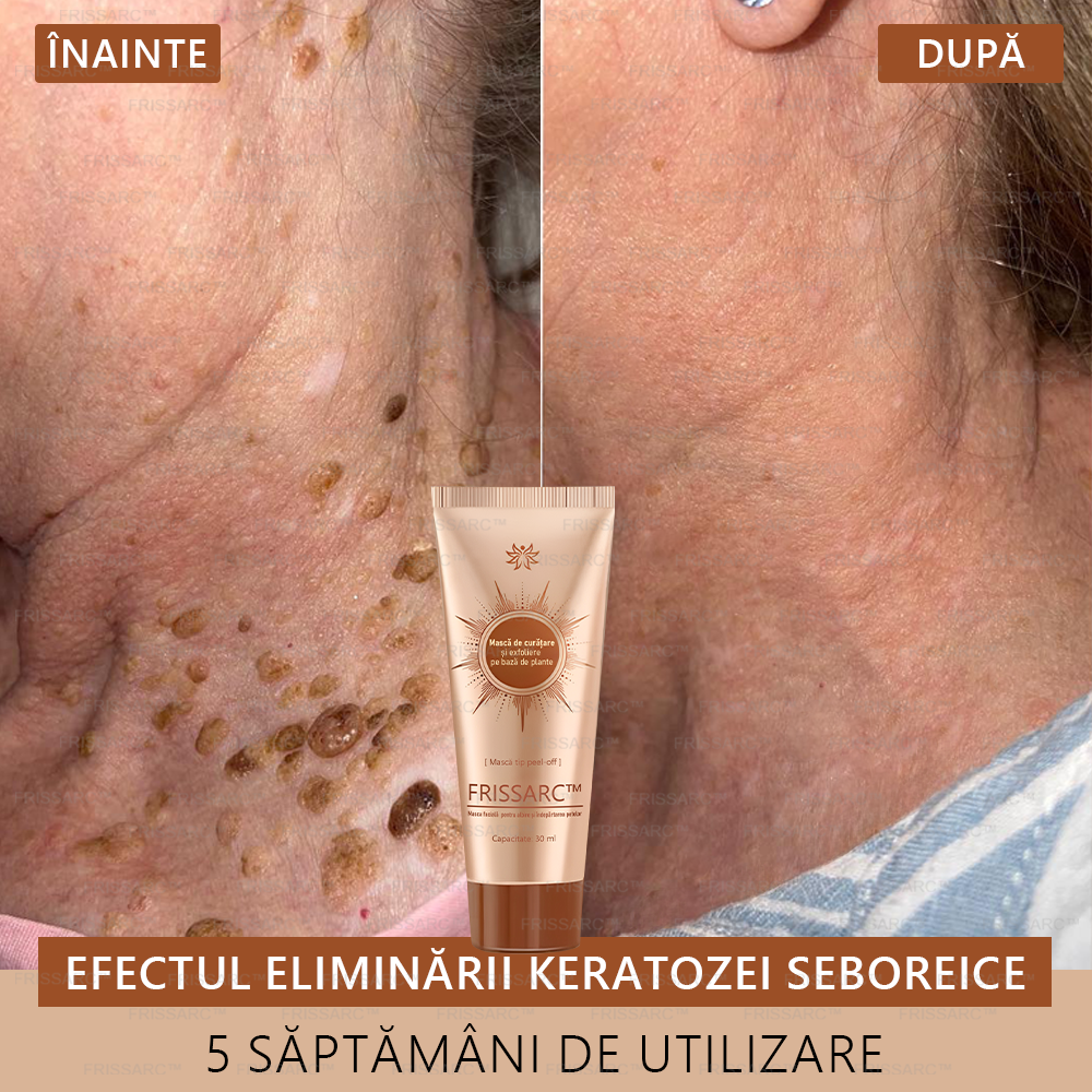 💟💟FRISSARC™ masca facială  pentru albire și îndepărtarea petelor –🍀Ingredientele naturale ajută la eliminarea eficientă și de durată a petelor pigmentare, petelor de vârstă, pistruilor și petelor solare.