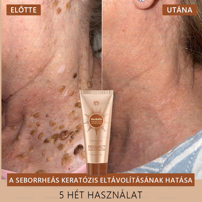 𝐅𝐑𝐈𝐒𝐒𝐀𝐑𝐂™ Fehérítő És Folteltávolító Arcmaszk | Természetes összetevők tartósan eltüntetik a foltokat, szeplőket és napfoltokat🔥