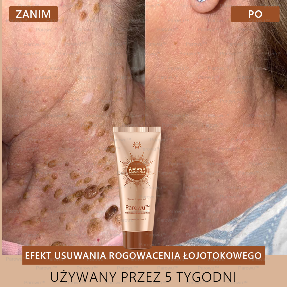 🔥 Parowu™ Wybielająca i Rozjaśniająca Maska - Naturalne składniki trwale usuwają plamy, piegi i przebarwienia🔥🔥🔥