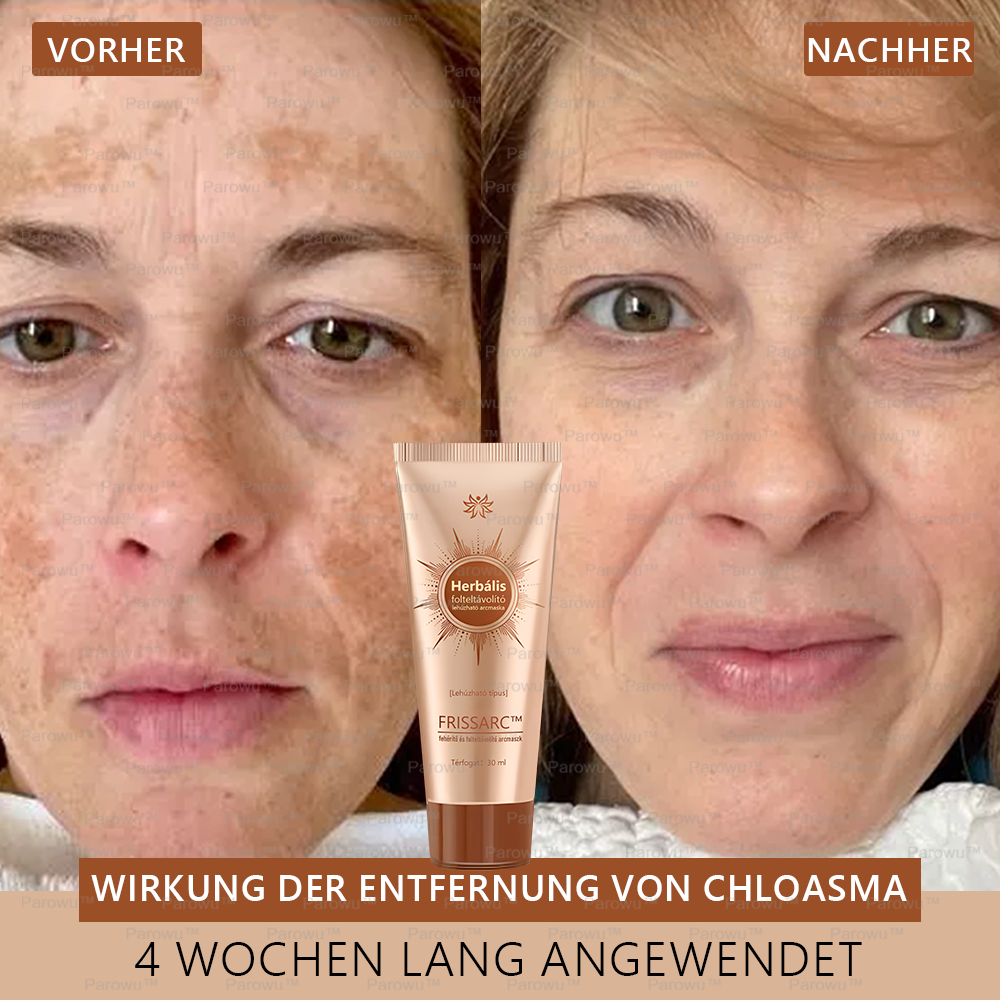 𝐅𝐑𝐈𝐒𝐒𝐀𝐑𝐂™ Fehérítő És Folteltávolító Arcmaszk | Természetes összetevők tartósan eltüntetik a foltokat, szeplőket és napfoltokat🔥