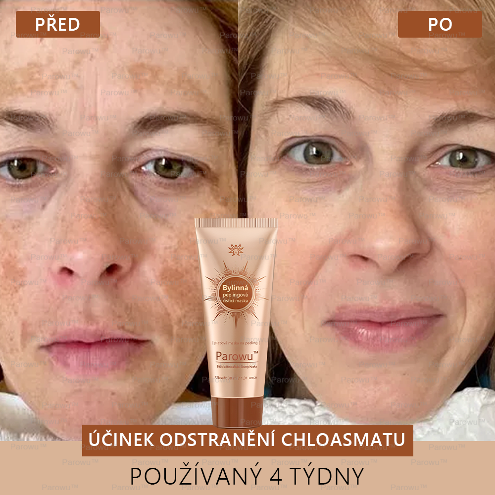 💟 Parowu™ Bělící a Odstraňující Skvrny Maska -🍀Přírodní složky trvale odstraňují pigmentové skvrny, stařecké skvrny, pihy a sluneční skvrny.